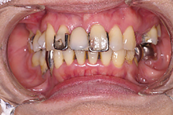 上の前歯治療前