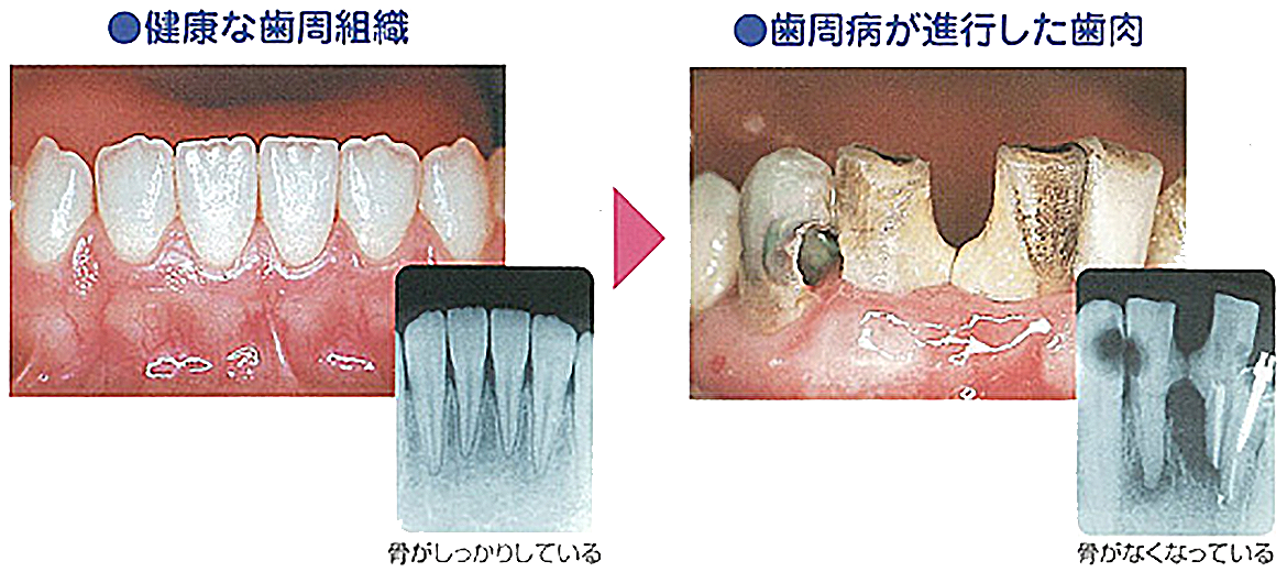 歯周病が進行すると・・・
