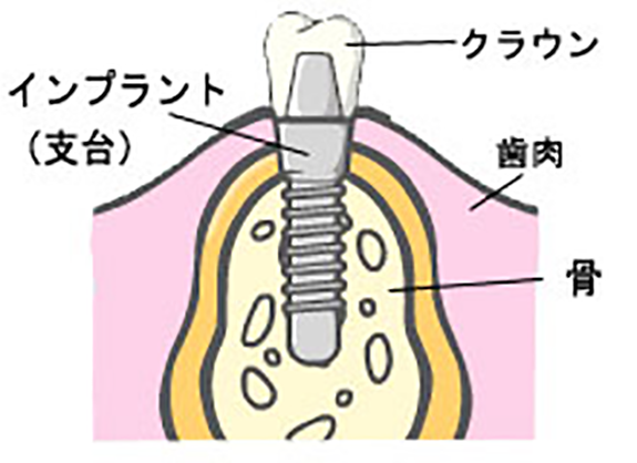 インプラントについて