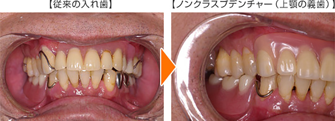 目立たない入れ歯【ノンクラスプデンチャー】治療例