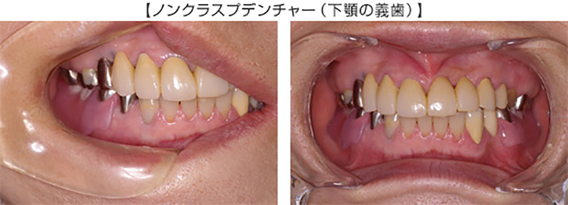 目立たない入れ歯【ノンクラスプデンチャー】治療例